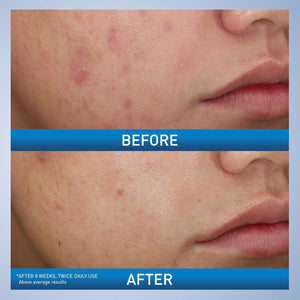 CeraVe Acne Foaming Wash price in Pakistan – non-drying, hydrating acne solution