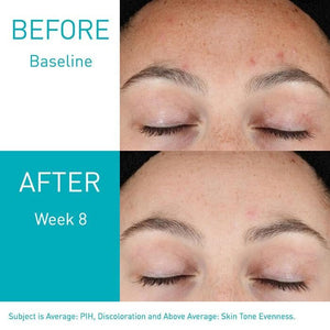 Cerave Resurfacing Retinol Serum before after