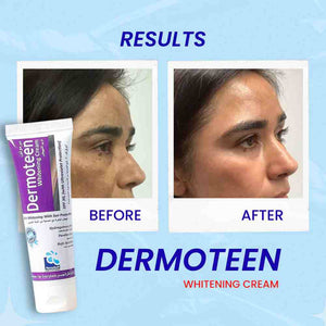 Dermoteen Whitening Cream