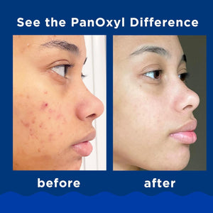PanOxyl Benzoyl Peroxide 10% acne treatment facewash