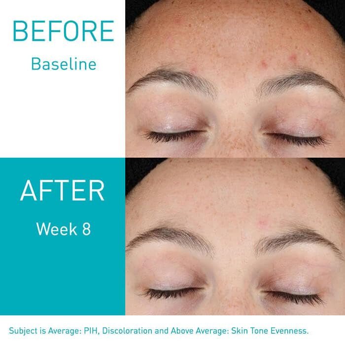 Cerave Resurfacing Retinol Serum before after